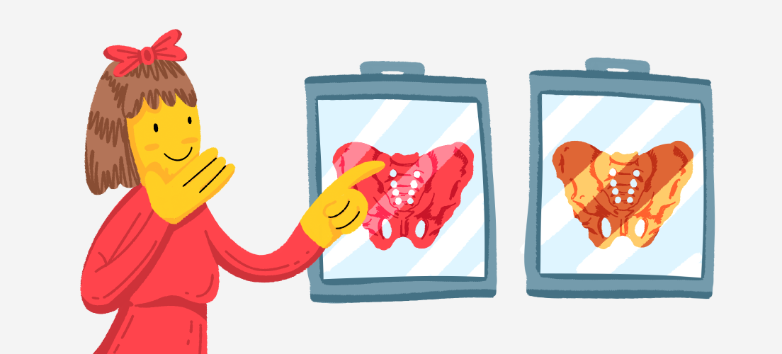 Звучит как план или не бойтесь менять тазобедренные суставы